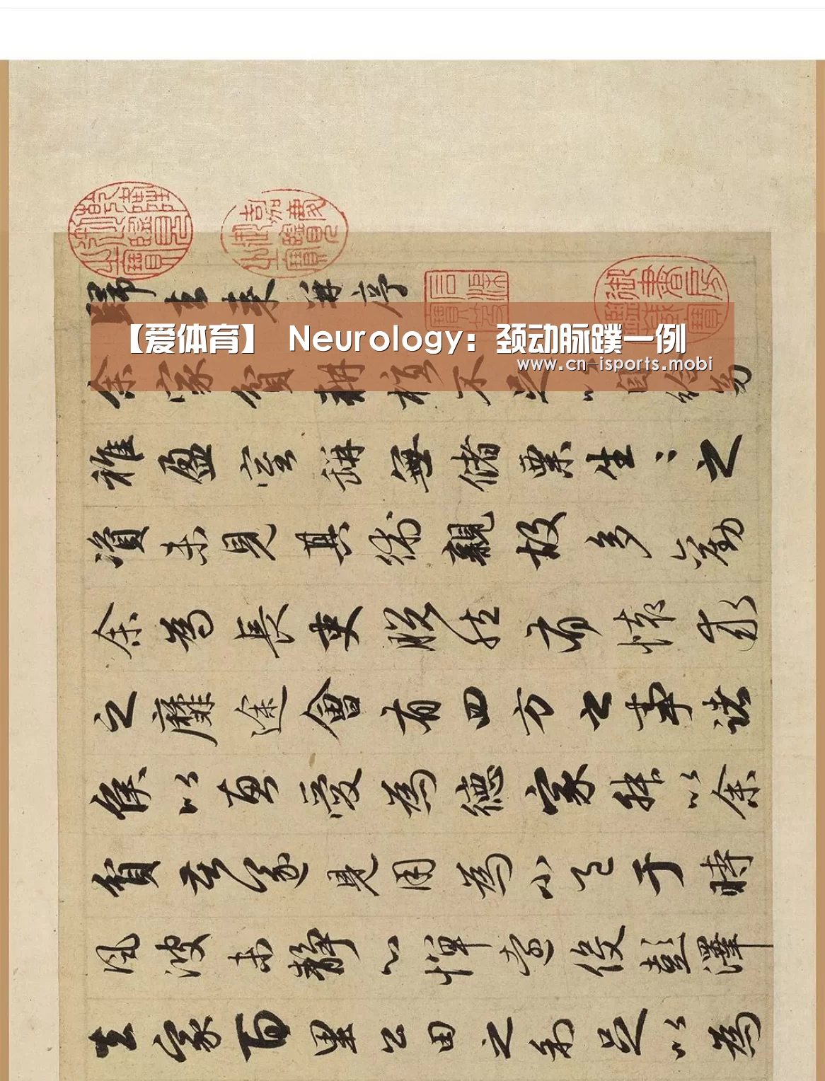 【爱体育】
Neurology:颈动脉蹼一例(图3) 爱体育